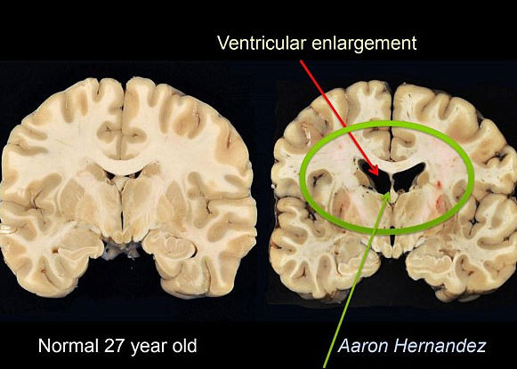 Trauma to brain of NFL's Aaron Hernandez was extensive: graphic
