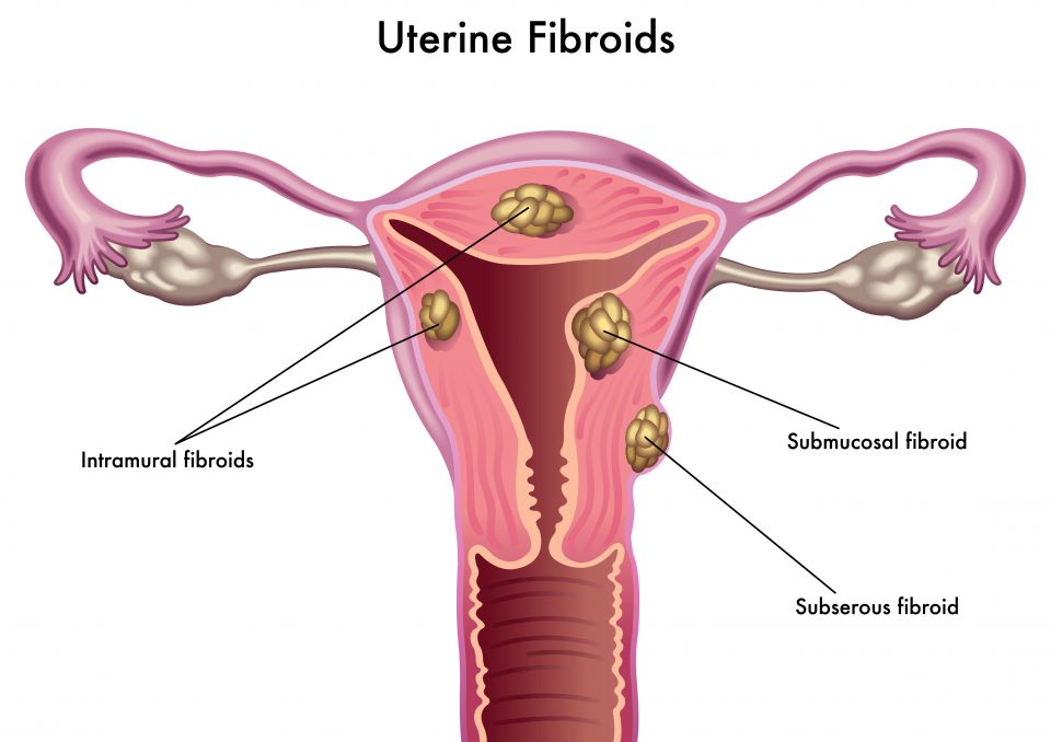 Why do fibroids affect so many Black women?