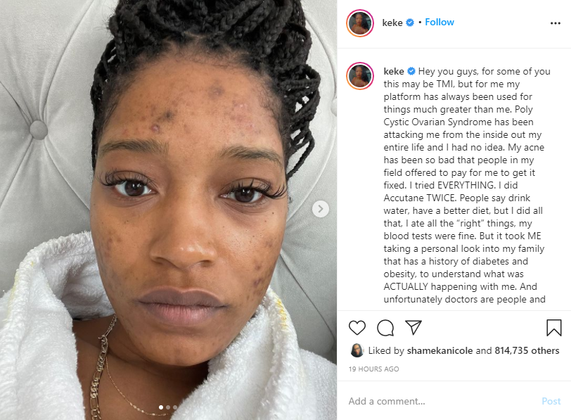 Keke Palmer reveals painful medical condition she's battled for years (photo)