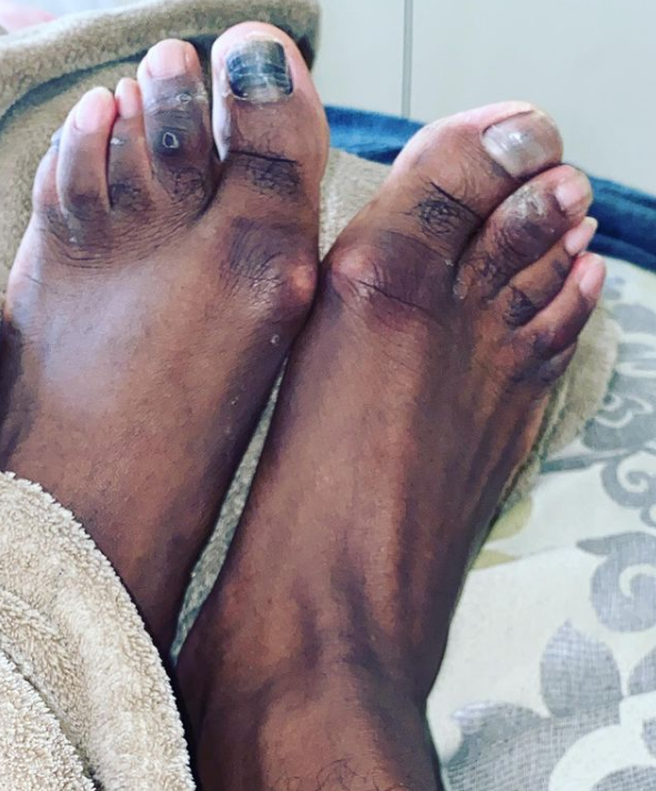 Adrien Broner claims he can't afford pedicure for hideous toes (photos)
