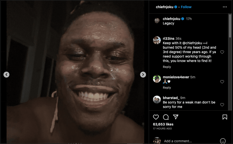 Cleveland Browns player shows severely burned face after accident (photo)