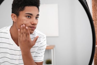 pimple patches on the face, freckles