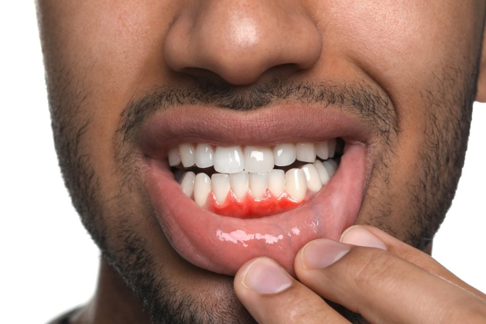 The link between diabetes and bloody gums