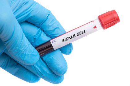 sickle cell