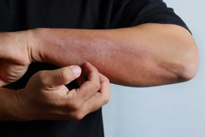 Find relief from stubborn eczema