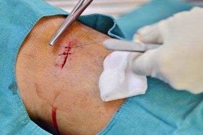 Wound stitch healing