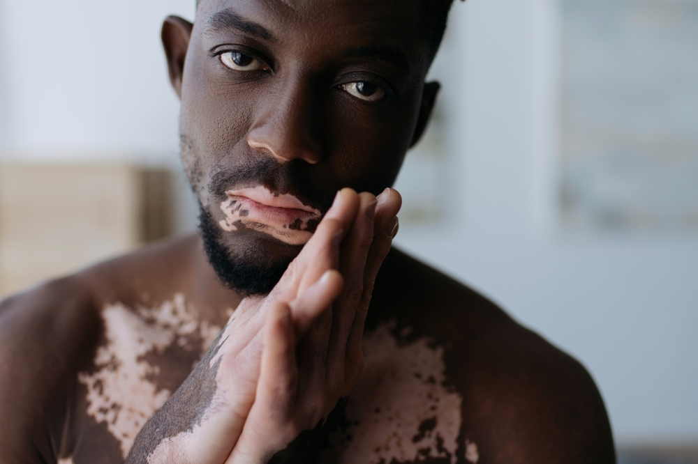 vitiligo, skin