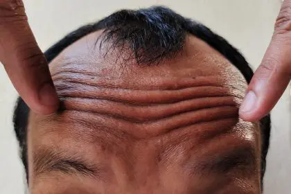 Truth about forehead wrinkles