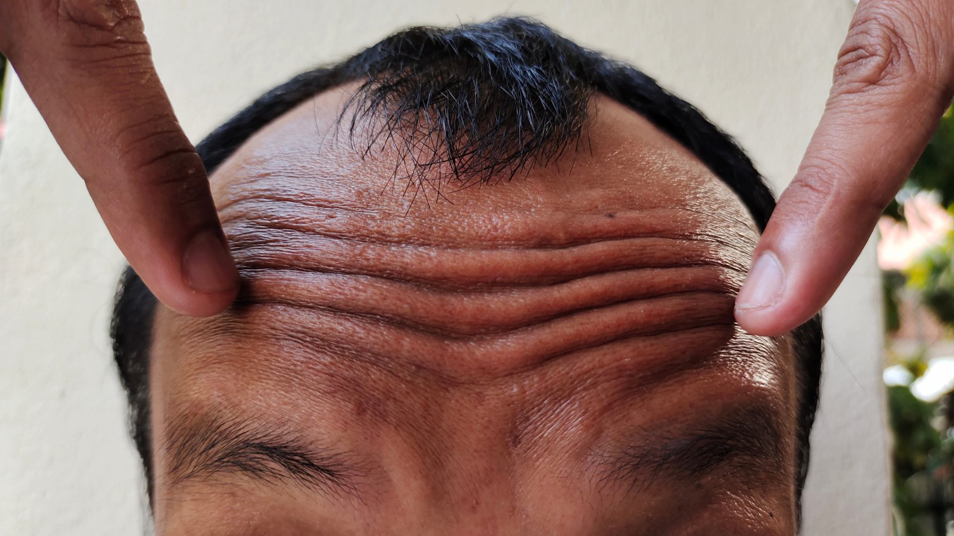 Truth about forehead wrinkles