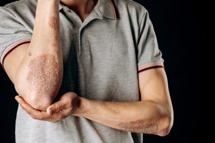 psoriasis, ringworm, skin, infection