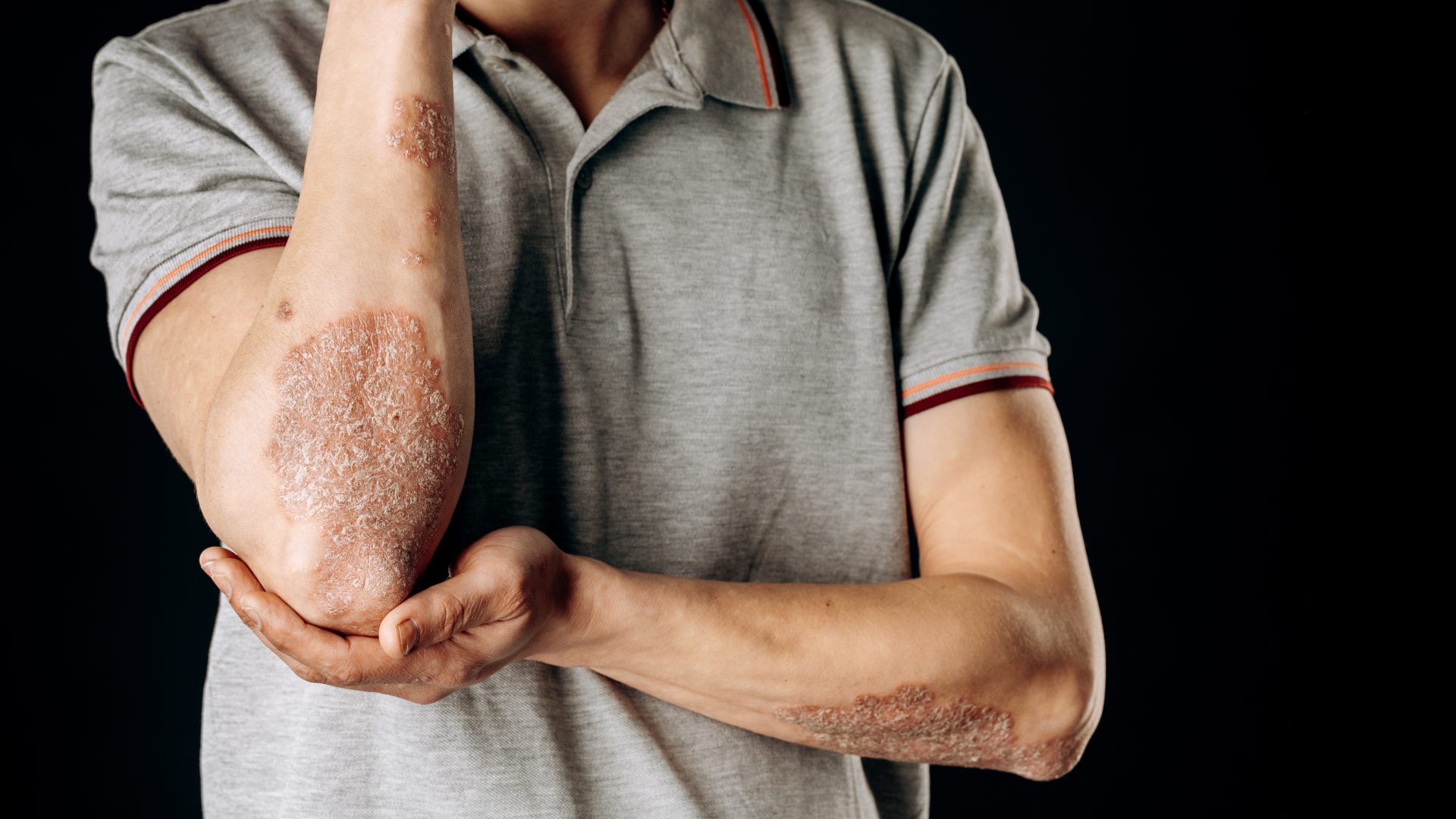 psoriasis, ringworm, skin, infection