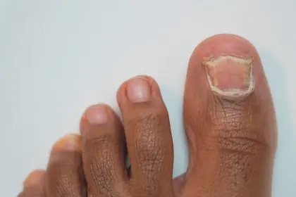 Expert recommendation for toenail
