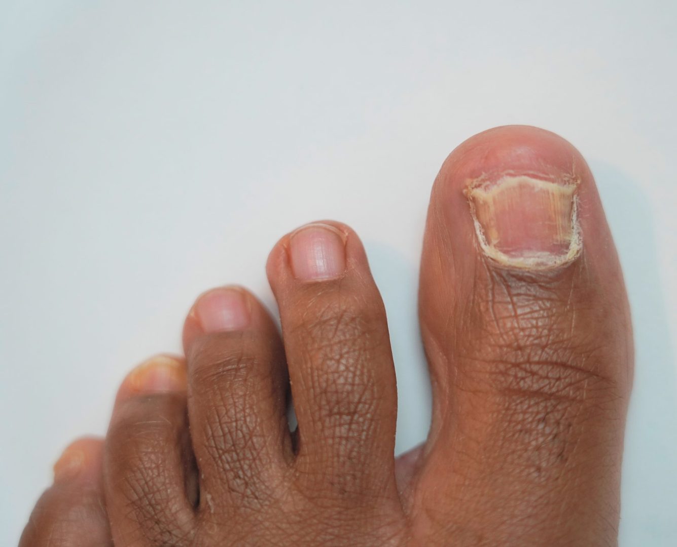 Garlic recommendation for YOUR toenail