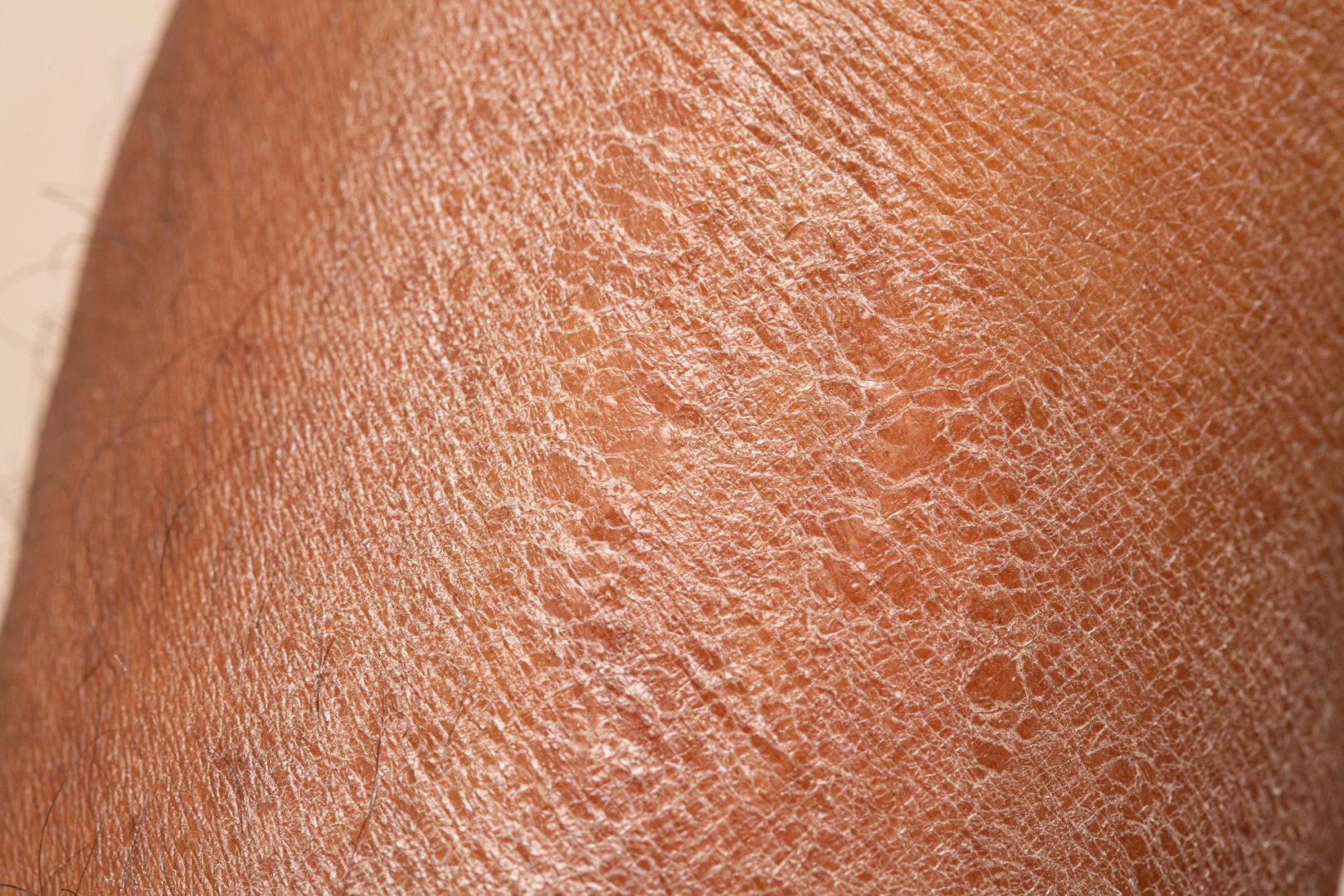 DRIED SKIN