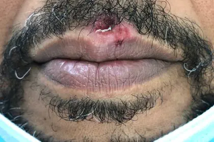 herpes virus triggers