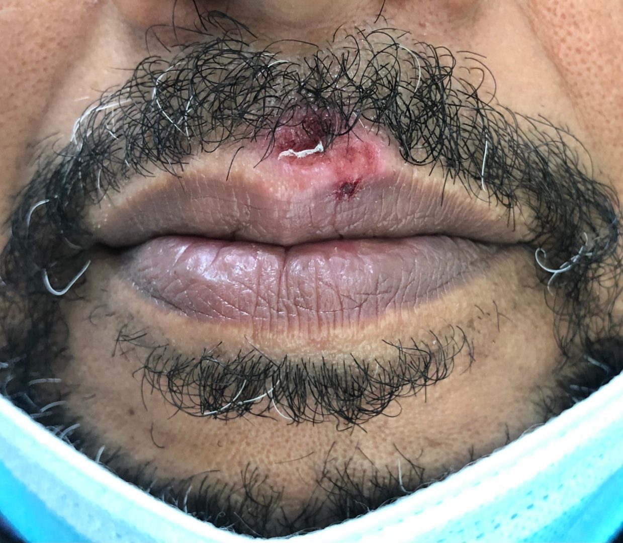 herpes virus triggers