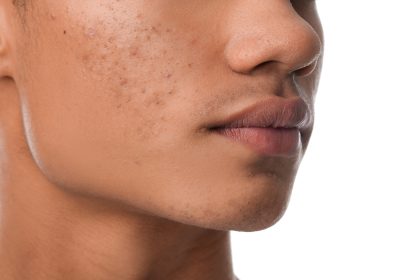 hormonal acne