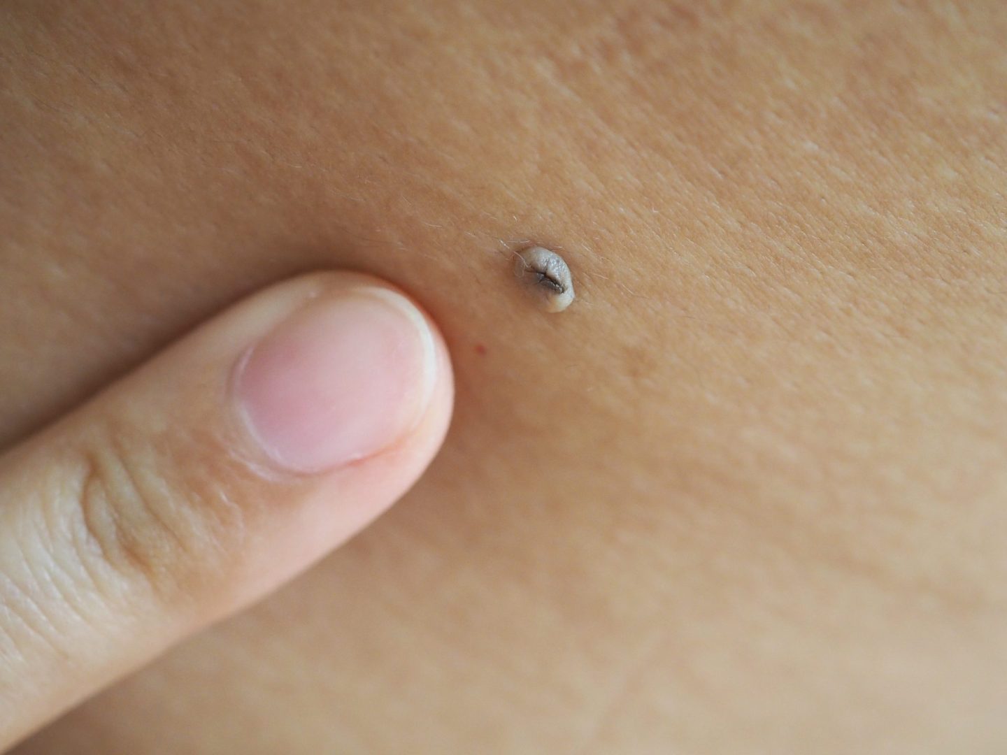 Skin tags