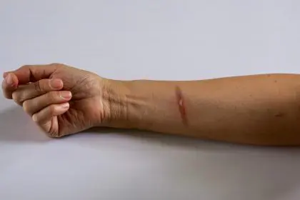 First 60 seconds after a burn