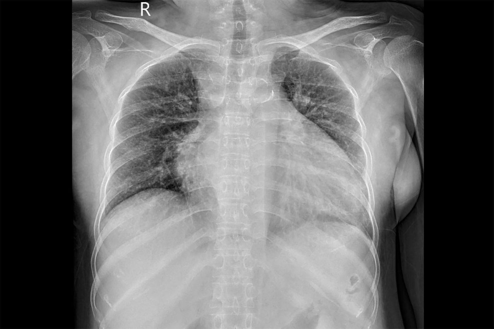 metastatic cancer warning