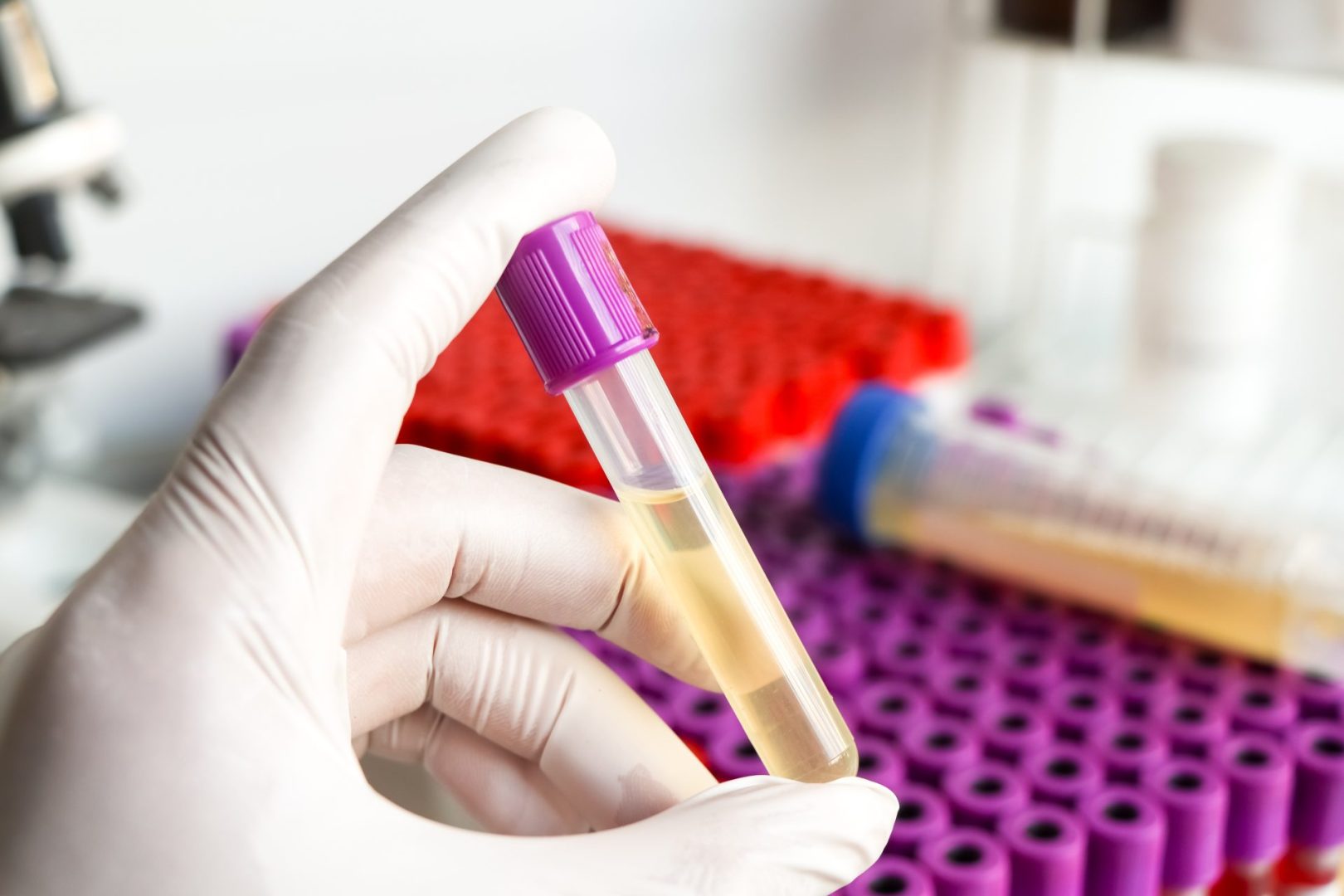 Urine test for prostate cancer