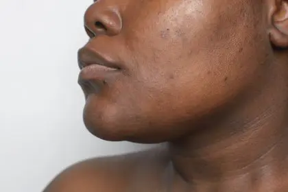 Dull, skin, glow
