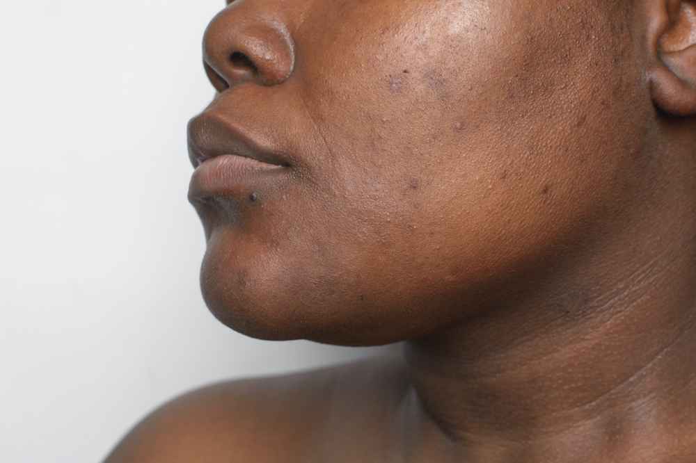 Dull, skin, glow