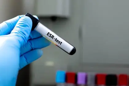 ESR test reveals