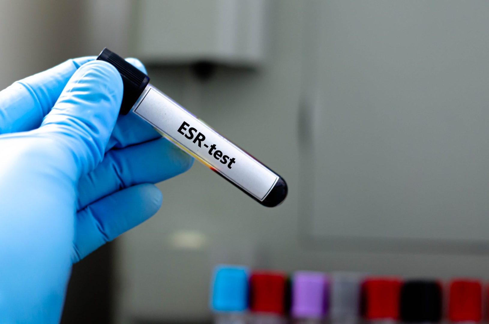 ESR test reveals