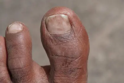 nail fungus versus psoriasis