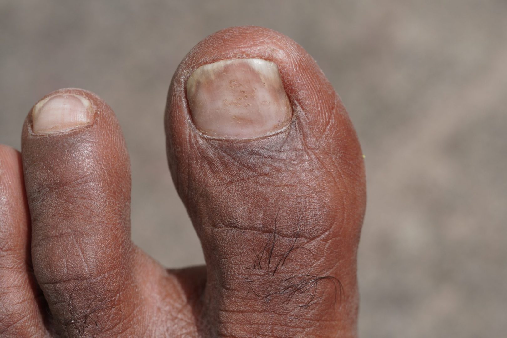 nail fungus versus psoriasis