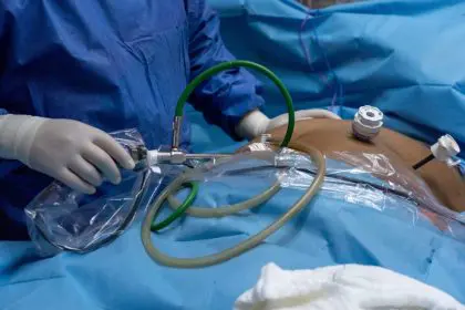 Gastric sleeve surgery