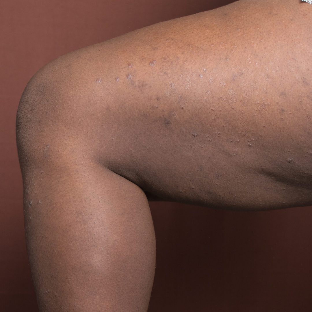 Eczema dark spot remedy