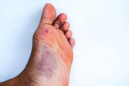 hemophilia isn't a death sentence