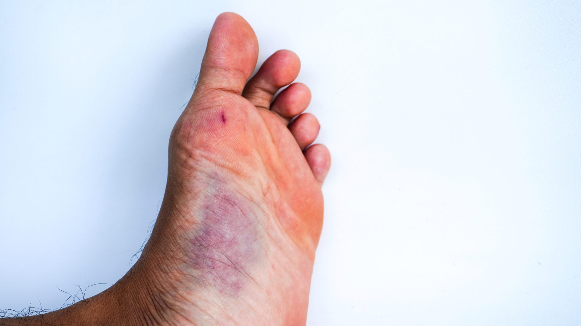 hemophilia isn't a death sentence