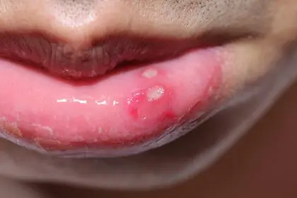 canker sore suffering