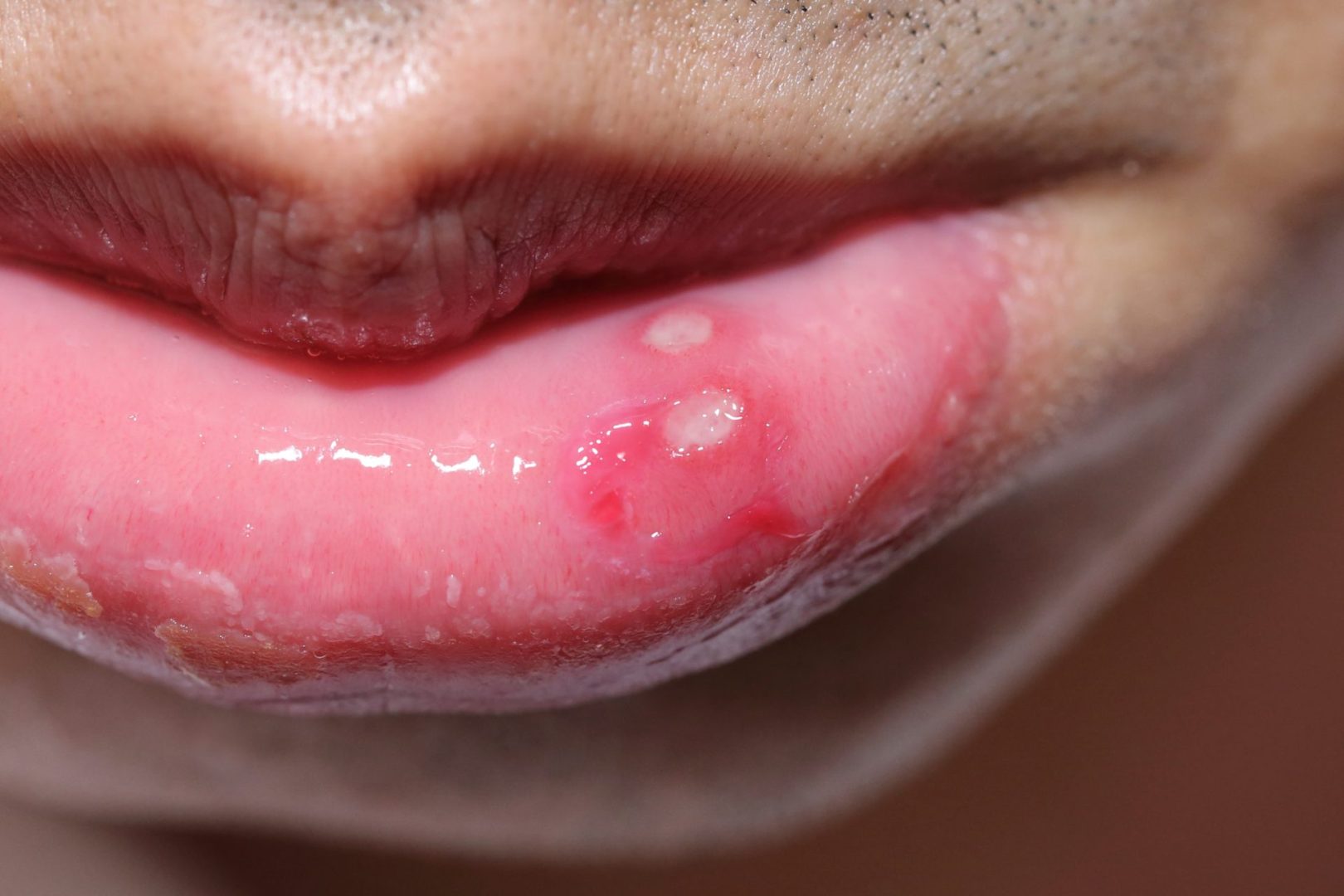 canker sore suffering