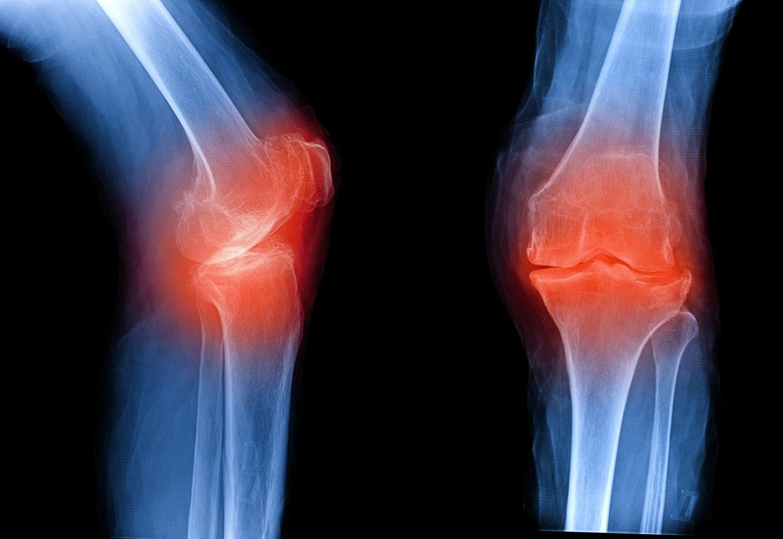 posterior knee pain
