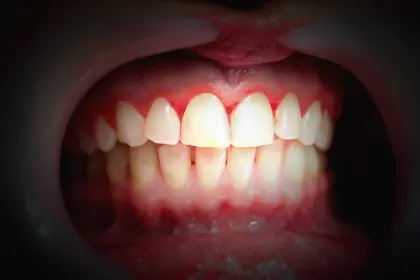 your gums bleed