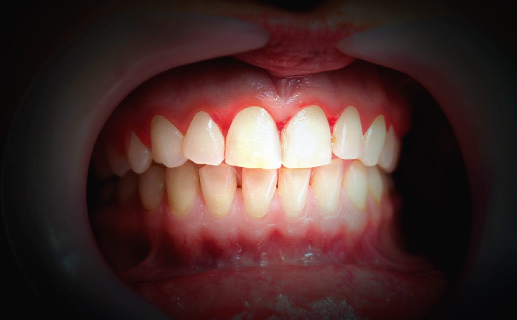 your gums bleed
