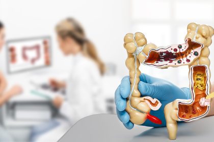 IBS and colon cancer