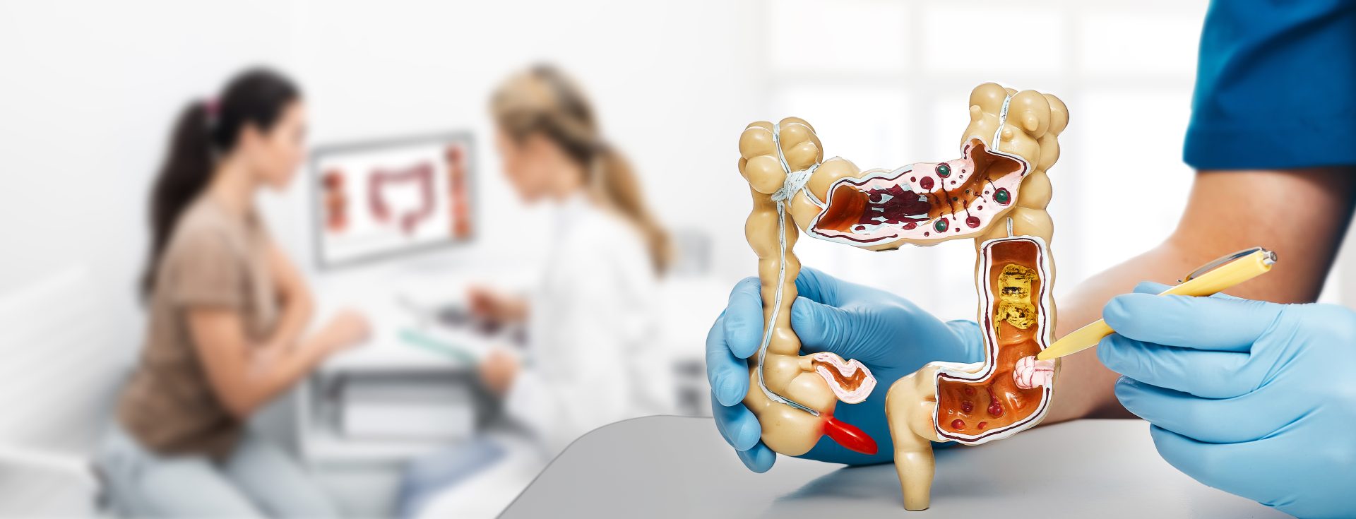 IBS and colon cancer