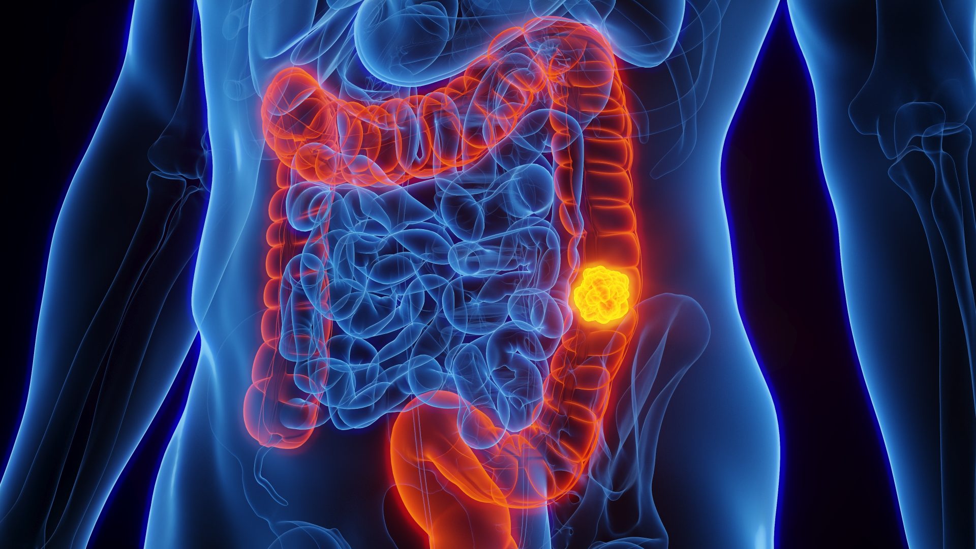 Stop colon cancer