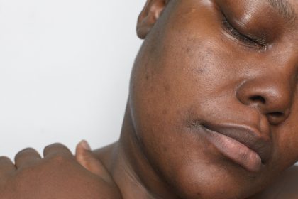 Dark spot, skin,