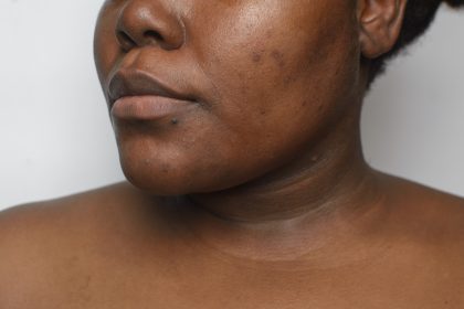 Dull skin culprits