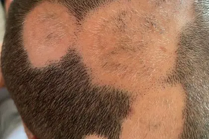 Outsmart alopecia areata