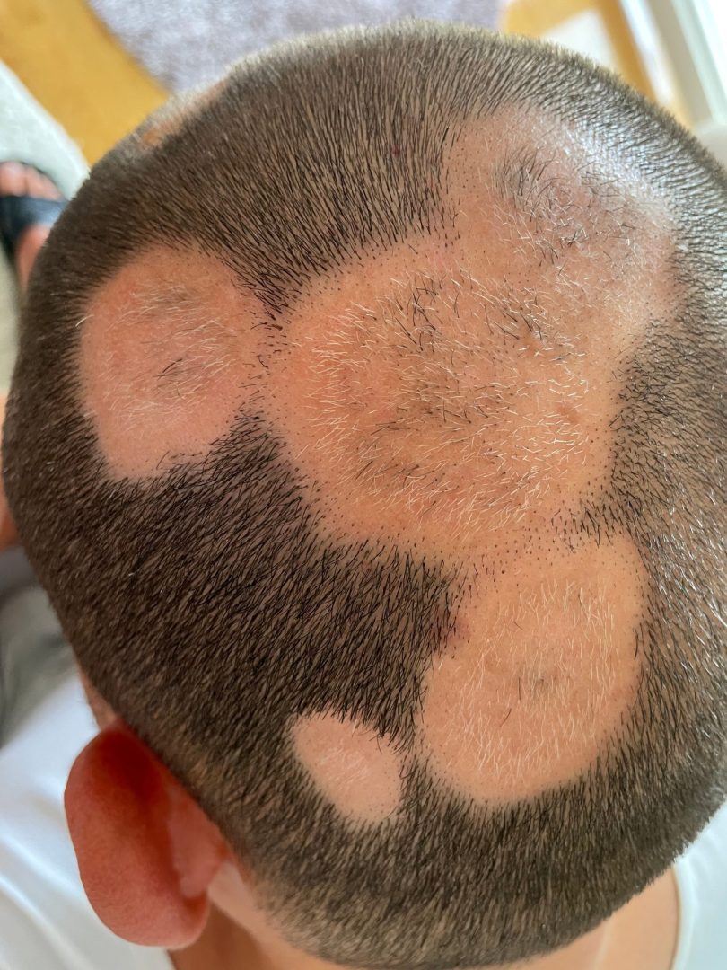 Outsmart alopecia areata