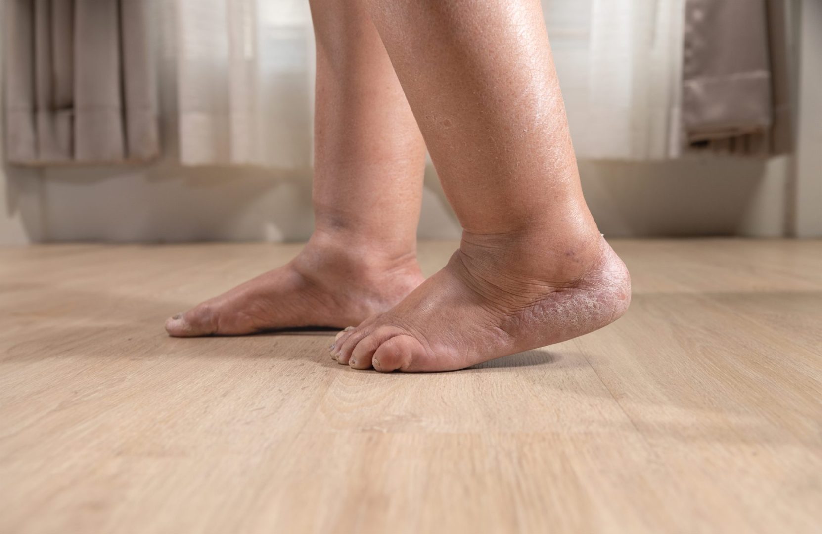 Ankle swelling that screams