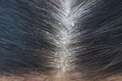 embarrassing scalp flakes