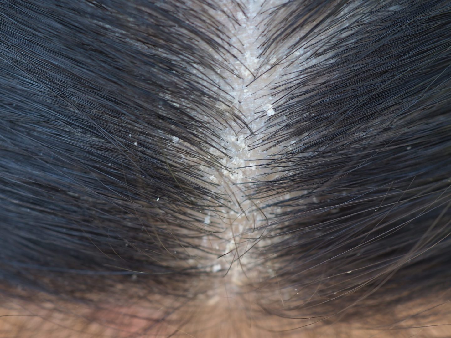 embarrassing scalp flakes